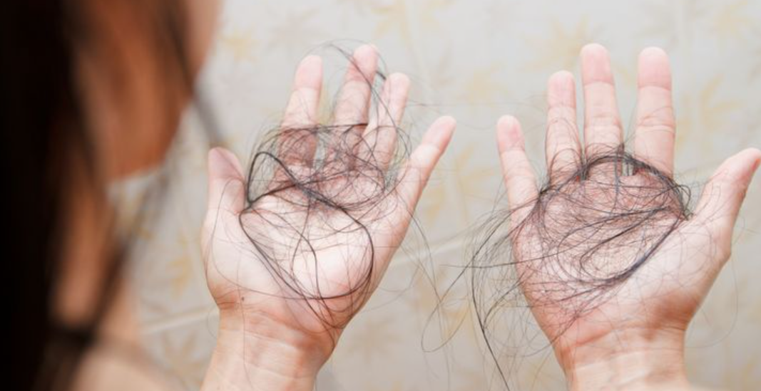 8 Penyakit yang Dapat Menyebabkan Rambut Rontok