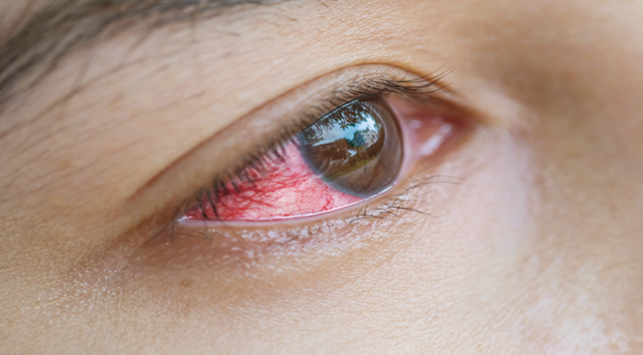 8 Fakta Bahaya Menggunakan Softlens pada Mata yang Harus Diketahui