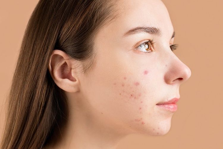 50 Skincare untuk Menghilangkan Bekas Jerawat, Rekomendasi Terbaik